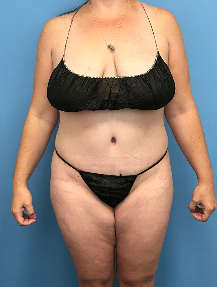 Front view image of a woman's abdomen showing results after tummy tuck surgery.