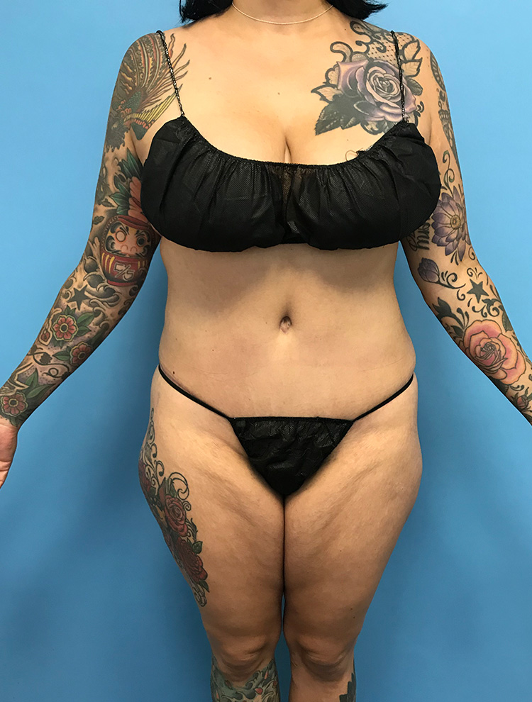 A front view of a female patient with tattoos after tummy tuck surgery, showing a flatter abdomen and tighter skin.