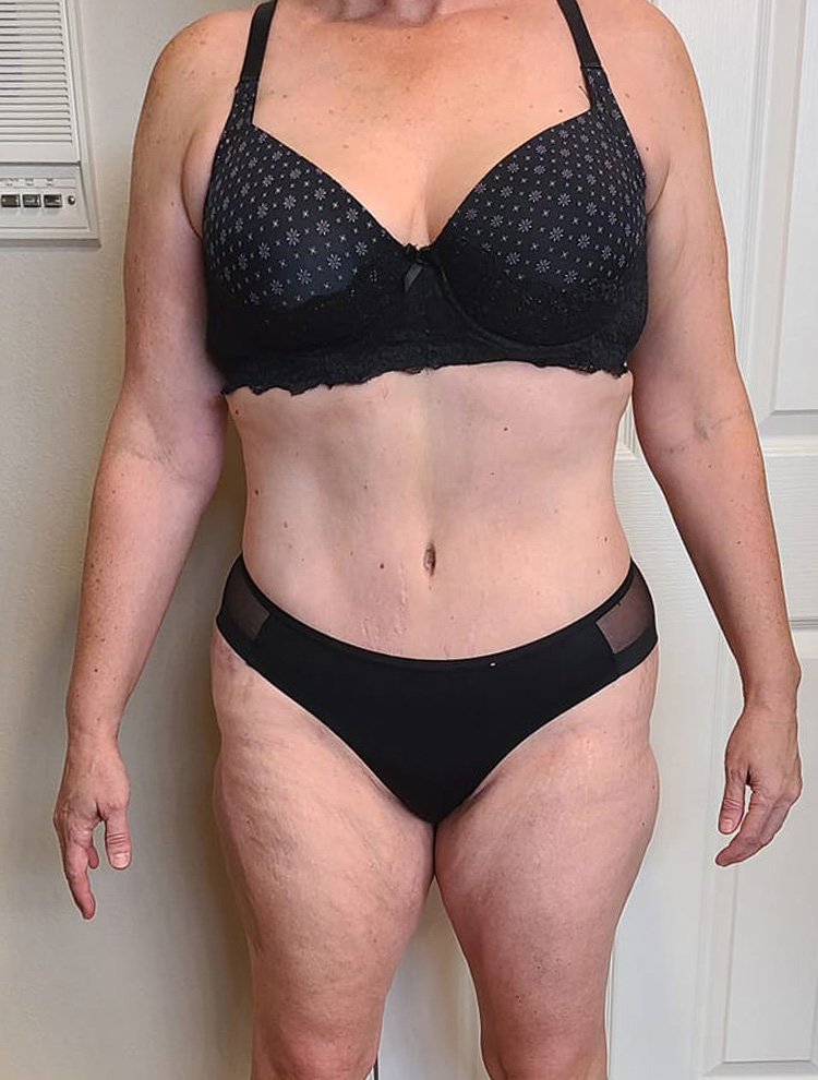 Front view of a woman's body showcasing results after tummy tuck surgery.