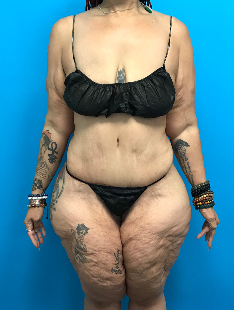 A front view of a female patient after tummy tuck surgery, showing reduced abdominal volume and improved waist contour.