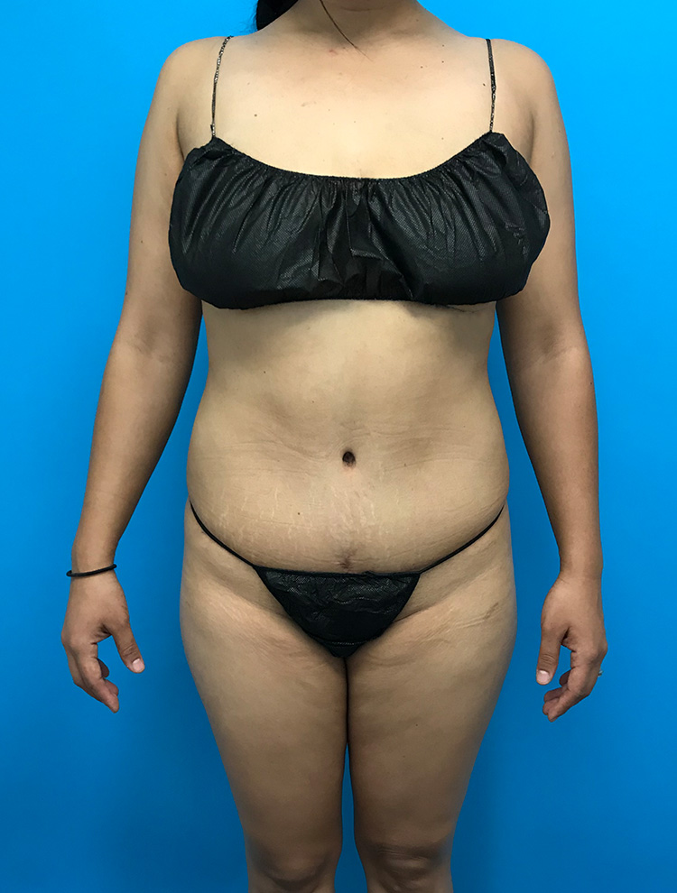 Tummy Tuck after photo front view - Dr. Cat Beverly Hills