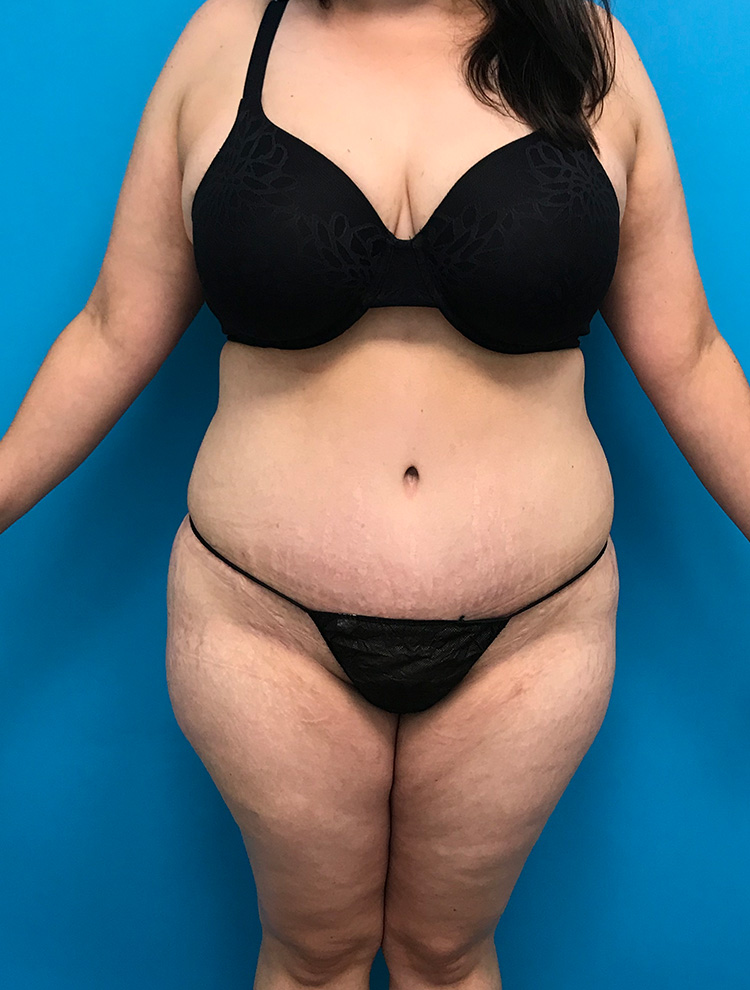 Front view of a woman's body after tummy tuck surgery, showcasing smoother abdominal contours.
