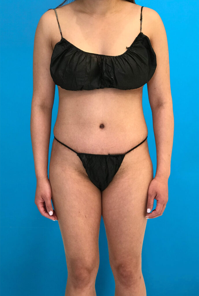 Case TTK-0806 after photo — Dr. Cat, Beverly Hills