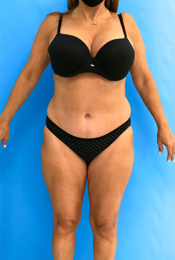 Case TTK-0815 after photo — Dr. Cat, Beverly Hills