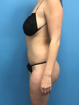 Side view of patient's abdomen after tummy tuck procedure showing flat, tightened stomach.