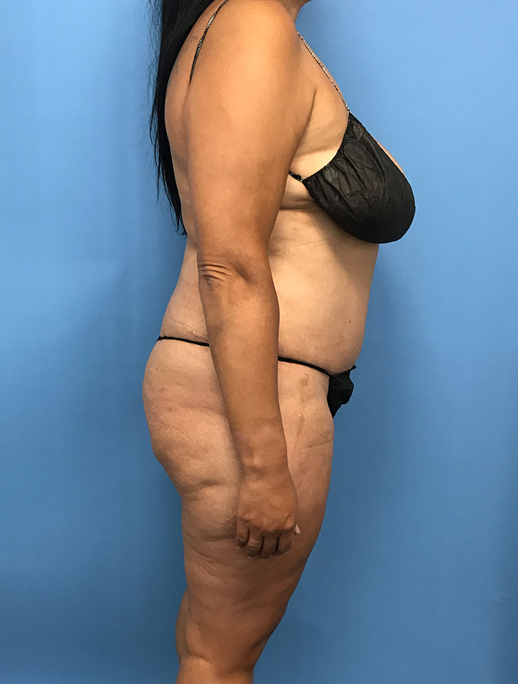 Tummy Tuck after photo side view - Dr. Cat Beverly Hills