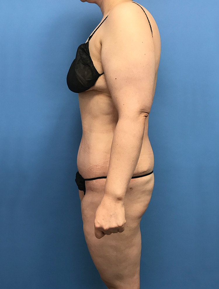 Tummy Tuck after photo side view - Dr. Cat Beverly Hills