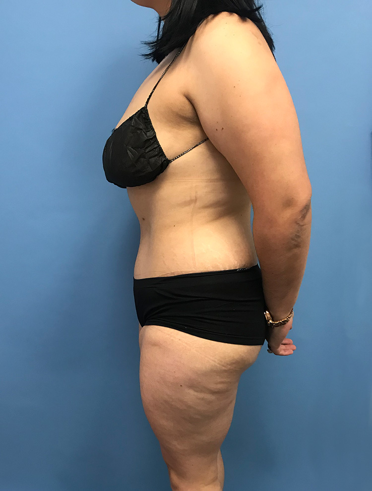 Tummy Tuck after photo side view - Dr. Cat Beverly Hills