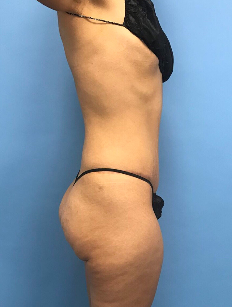 Tummy Tuck after photo side view - Dr. Cat Beverly Hills