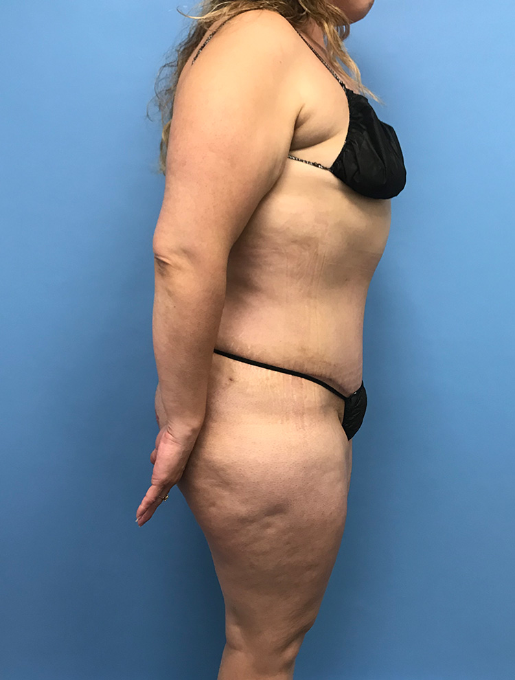 Tummy Tuck after photo side view - Dr. Cat Beverly Hills