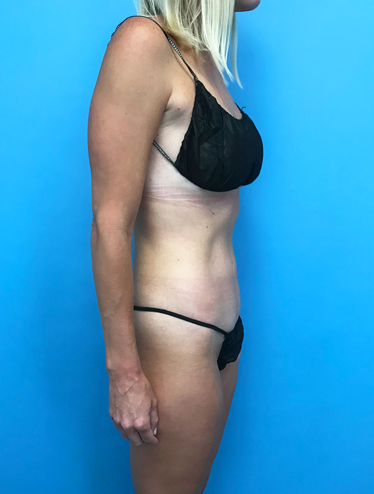 Tummy Tuck after photo side view - Dr. Cat Beverly Hills