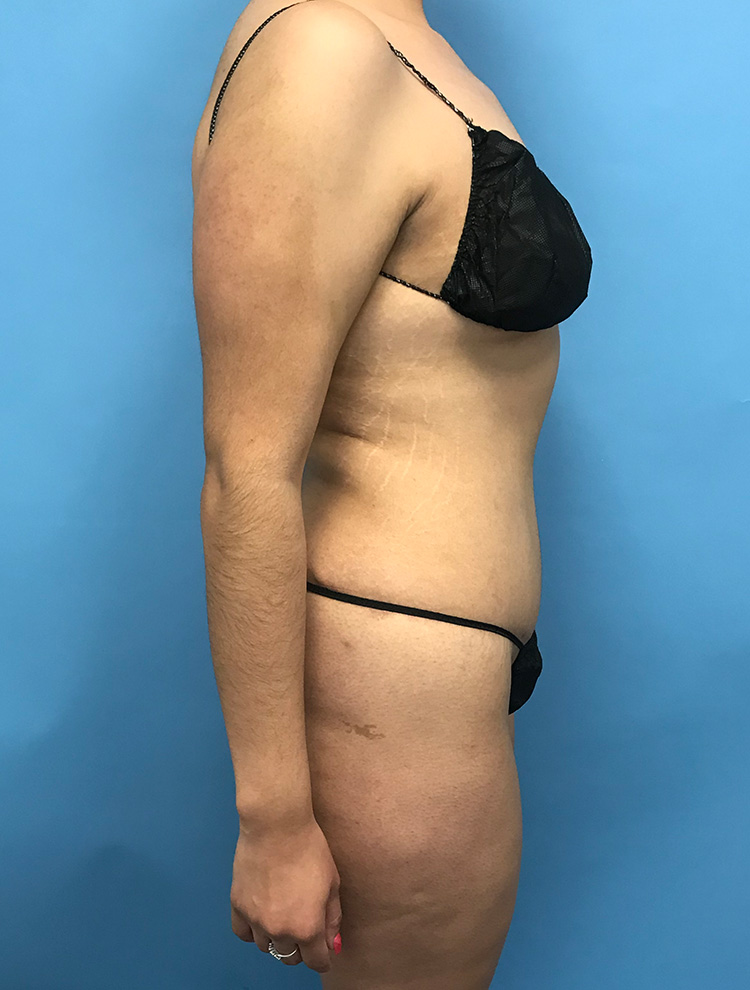 A woman shown from the side after a tummy tuck procedure, wearing black lingerie. The image shows her improved abdominal contour post-surgery.