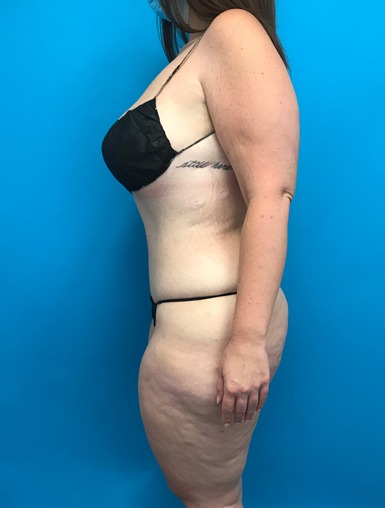 Tummy Tuck after photo side view - Dr. Cat Beverly Hills
