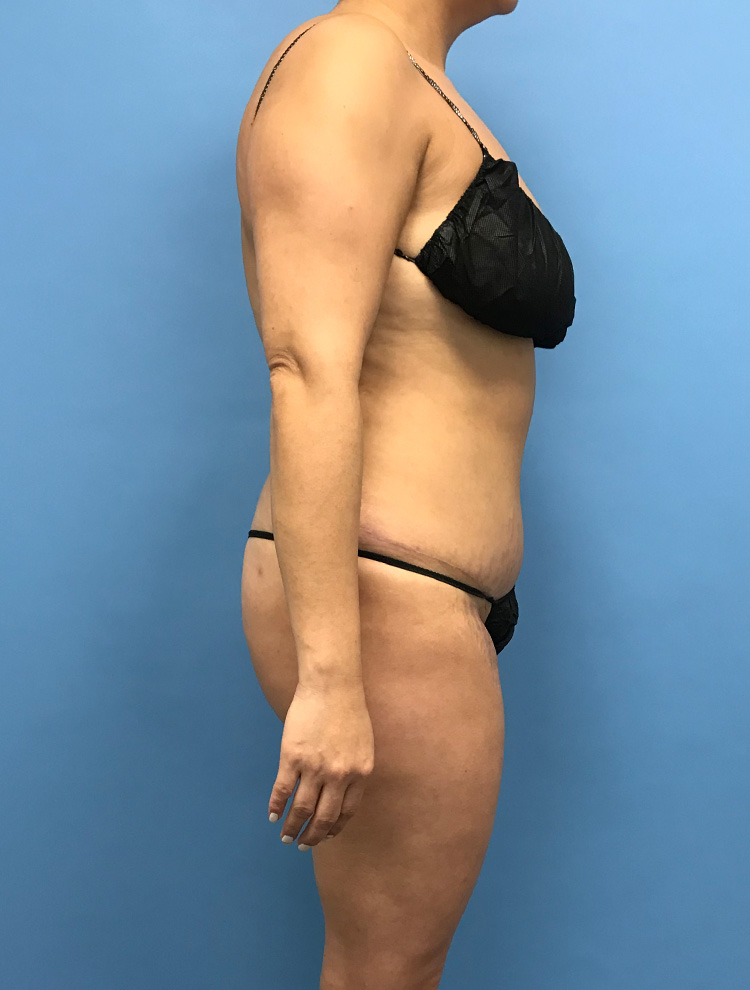 A woman shown from the side after a tummy tuck procedure, wearing black lingerie. The image shows her improved abdominal contour post-surgery.