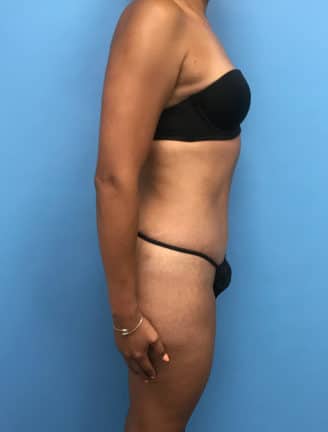 Tummy Tuck after photo side view - Dr. Cat Beverly Hills