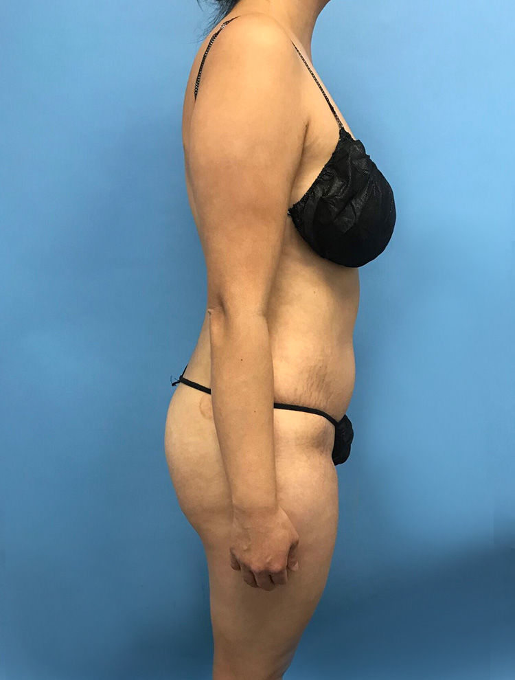 Profile view of a woman's body after cosmetic procedure, showing toned abdomen and slimmer body contour.