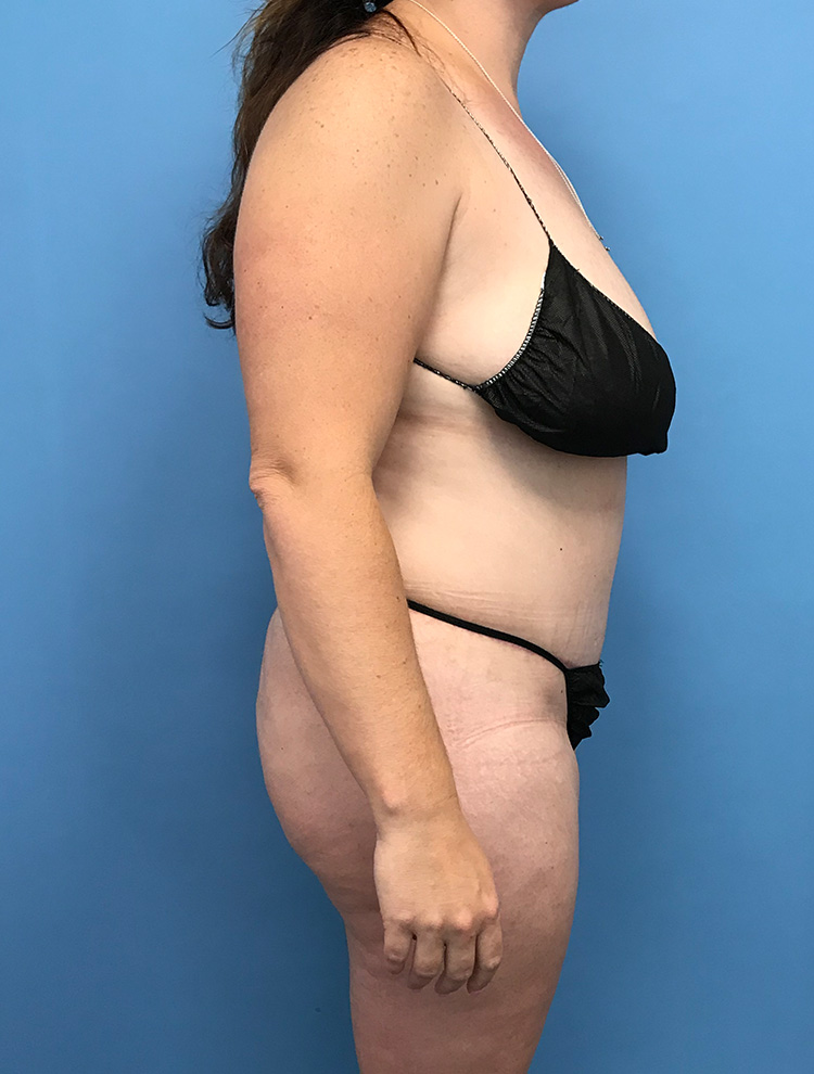 Side profile image of a woman's abdomen showing results after tummy tuck surgery.