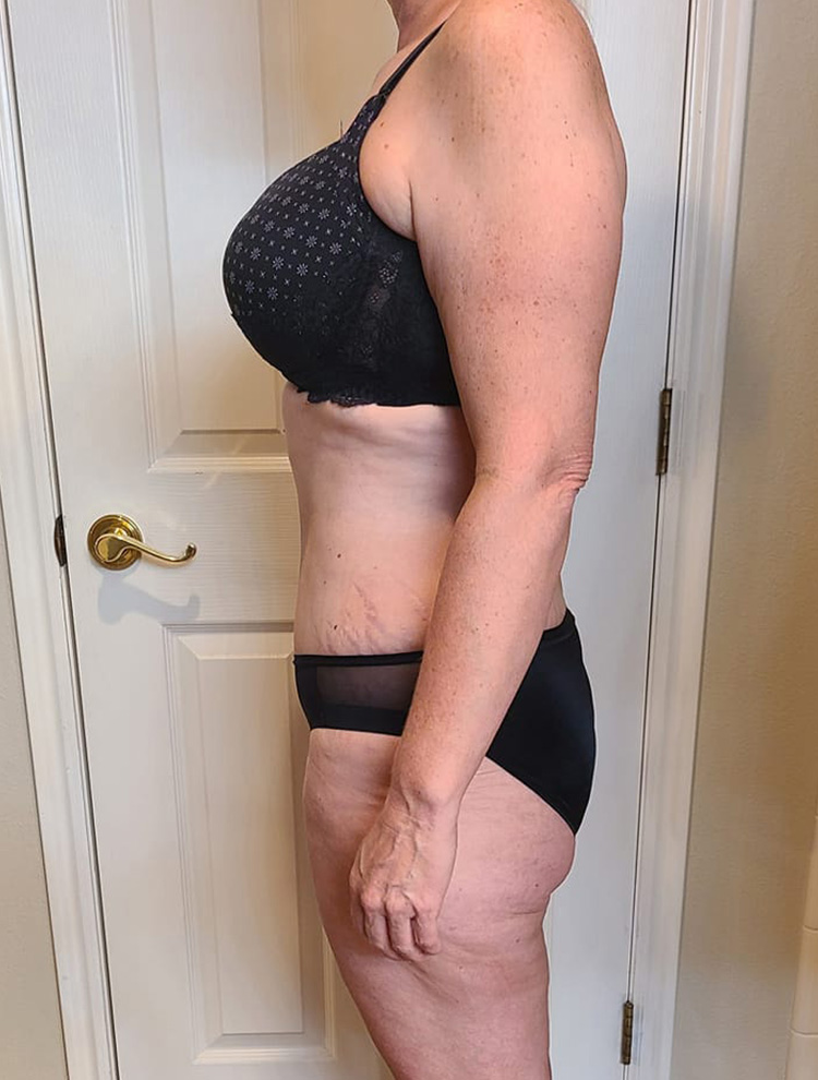 Side profile of a woman's body showcasing results after tummy tuck surgery.