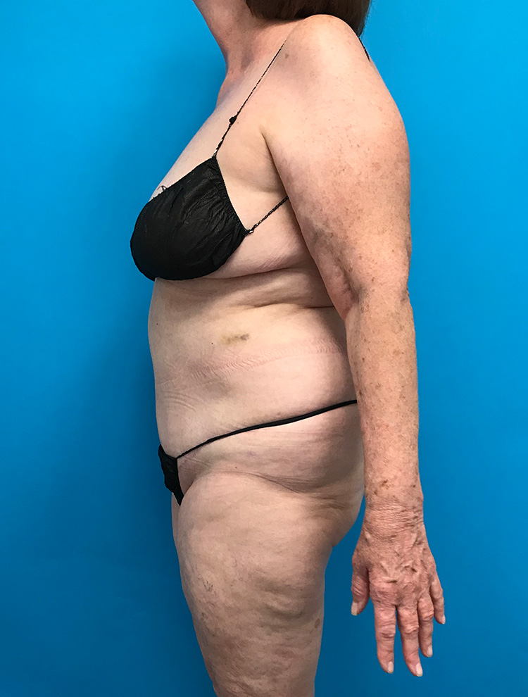 Side profile of a patient showing the abdomen before tummy tuck surgery.