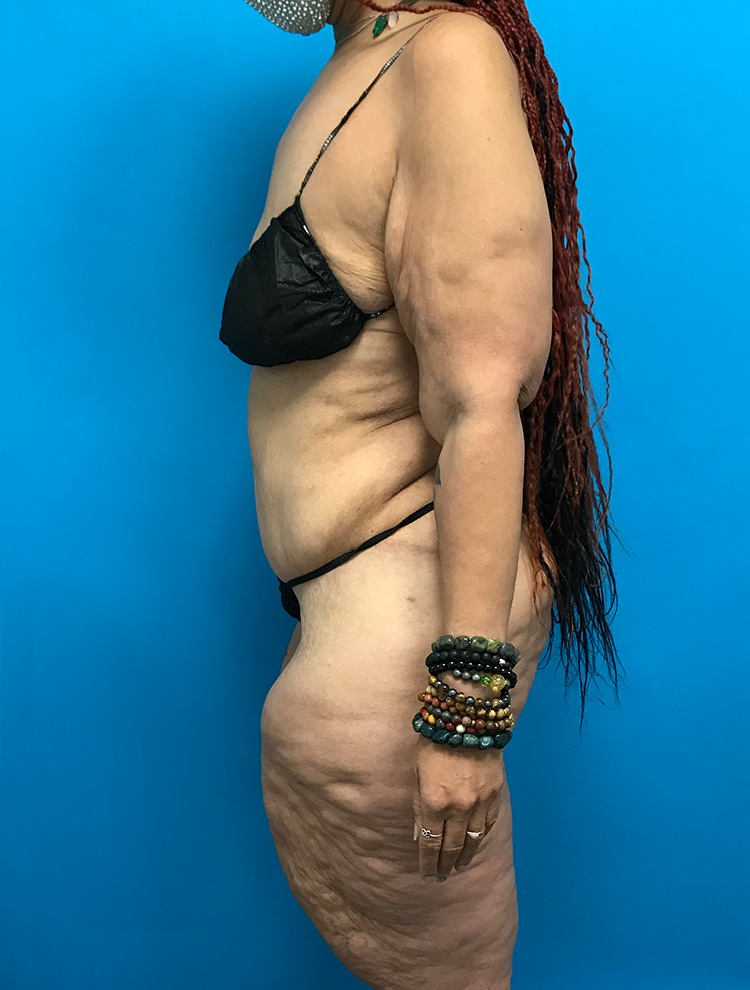 Side view of a female patient after tummy tuck surgery, showing reduced abdominal volume and improved waist contour.