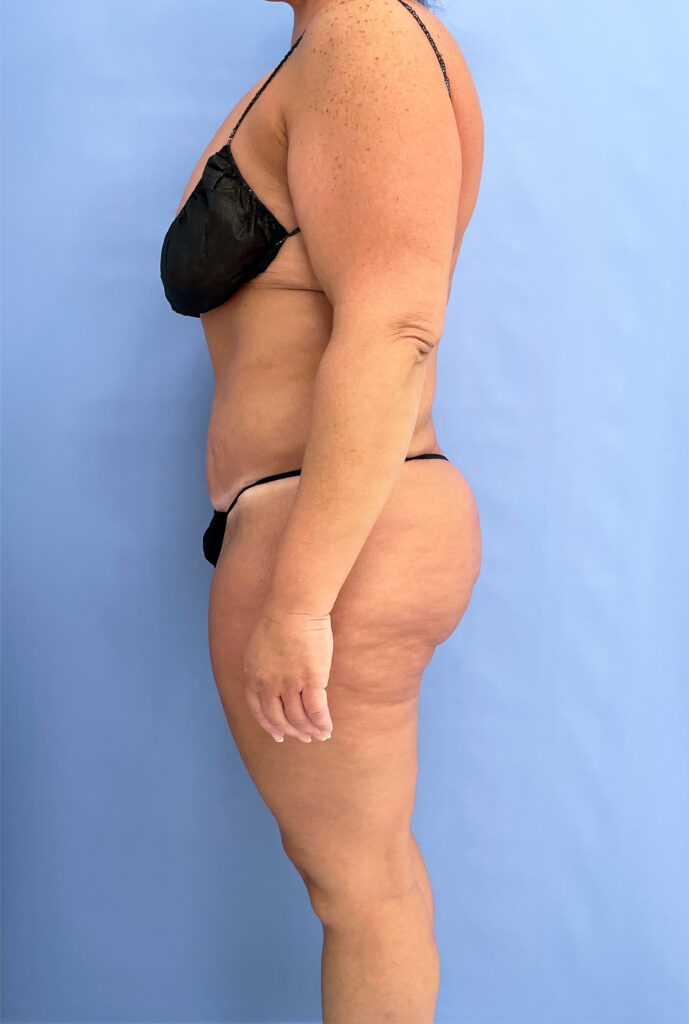 Case TTK-0735 after photo — Dr. Cat, Beverly Hills