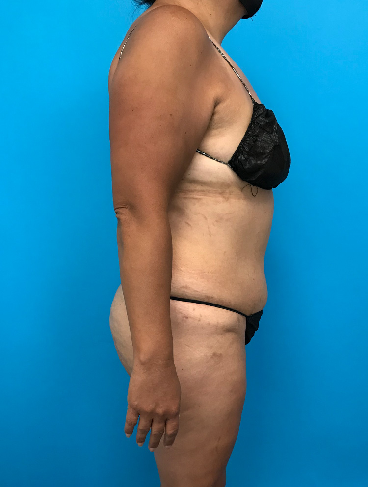 A woman shown from the side after a tummy tuck procedure, wearing black lingerie. The image highlights her improved abdominal contour following surgery.