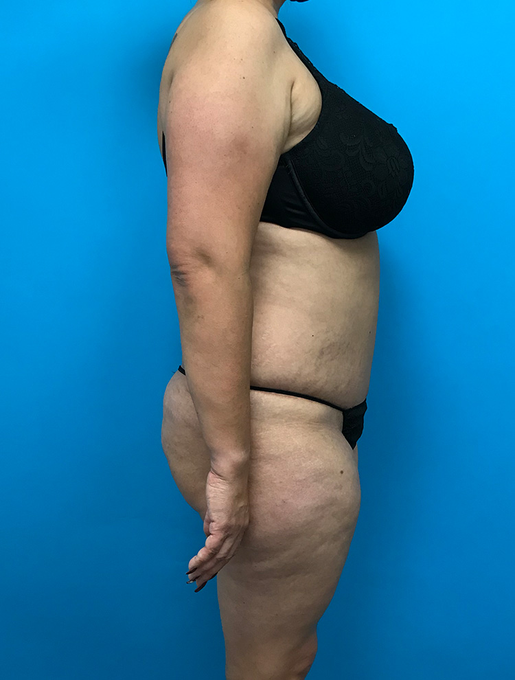 Side profile view of a woman's body after tummy tuck surgery, showing a flatter abdomen and smoother contours.