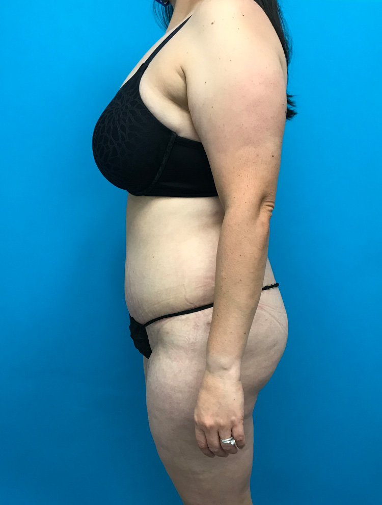 Side profile of a patient after tummy tuck surgery, illustrating a smoother, firmer abdominal contour.