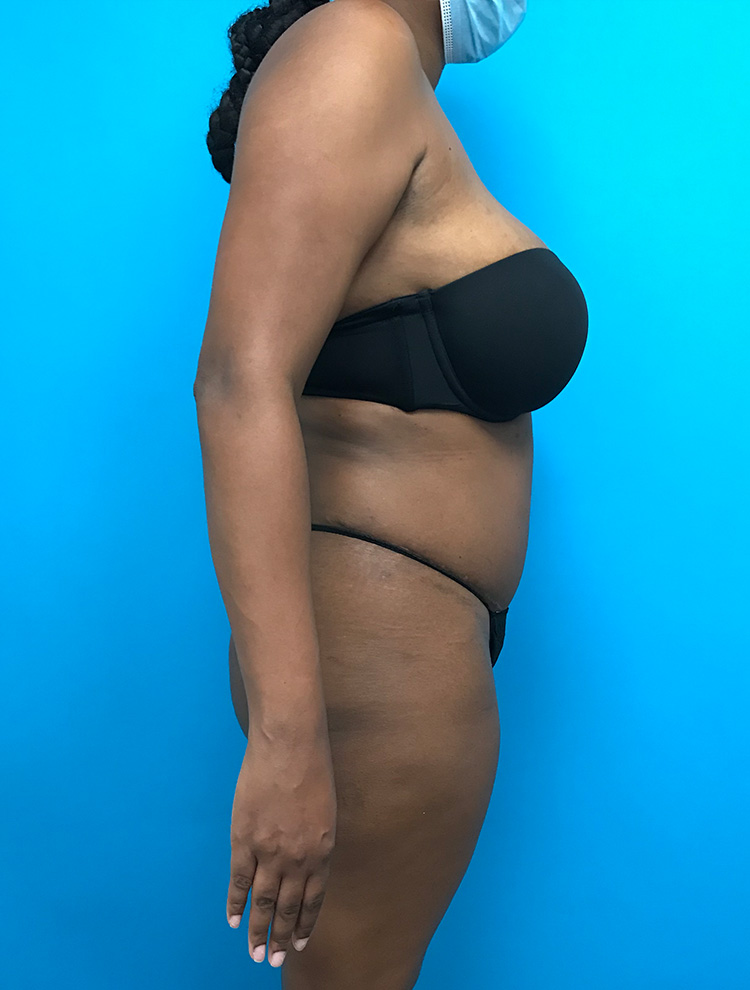 After image of a tummy tuck procedure showing the side of the patient.