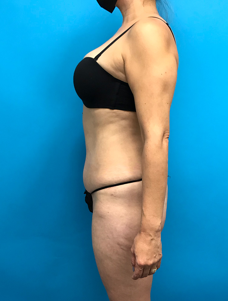 A woman shown from the side after a tummy tuck procedure, wearing black lingerie. The image highlights the abdominal area post-surgery, showing improved contour.