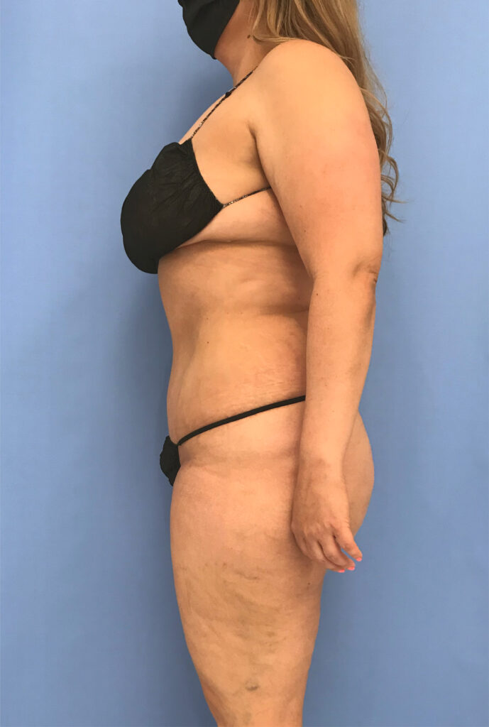 Case TTK-0774 after photo — Dr. Cat, Beverly Hills