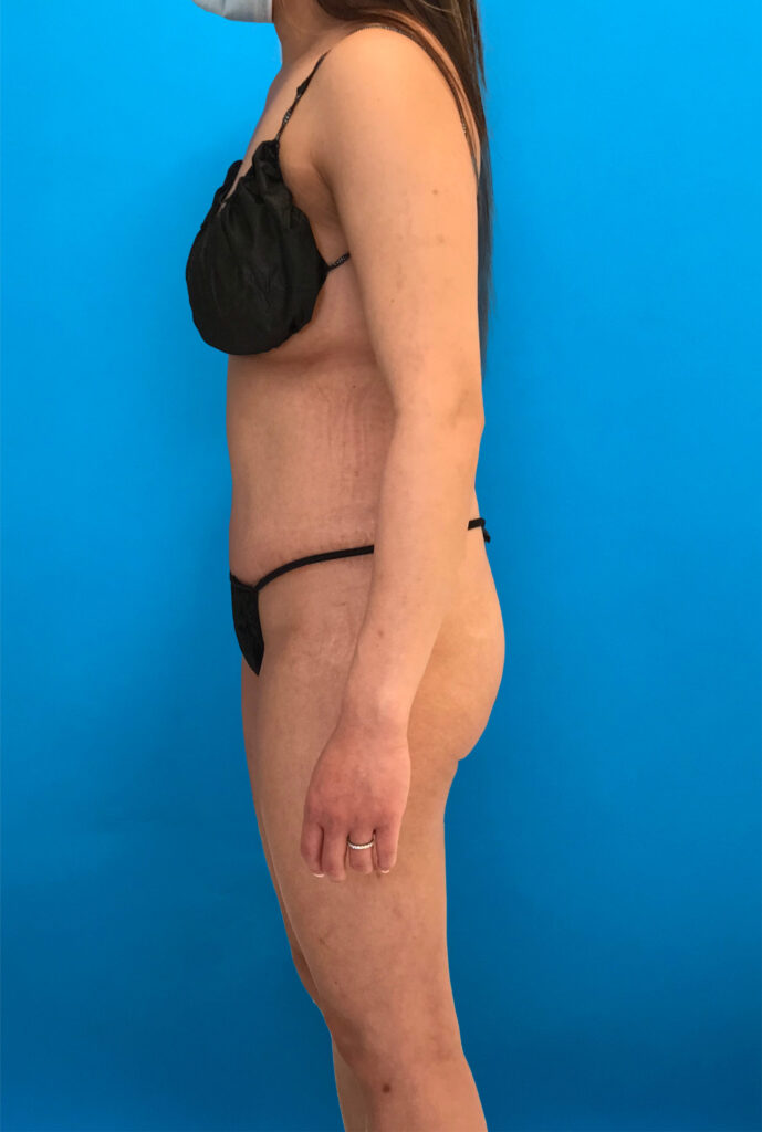 Case TTK-0806 after photo — Dr. Cat, Beverly Hills