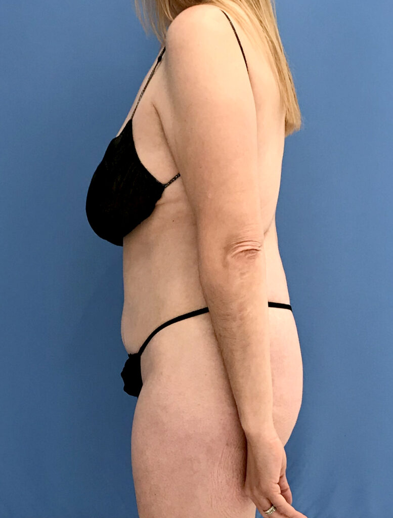 Case TTK-0819 after photo — Dr. Cat, Beverly Hills