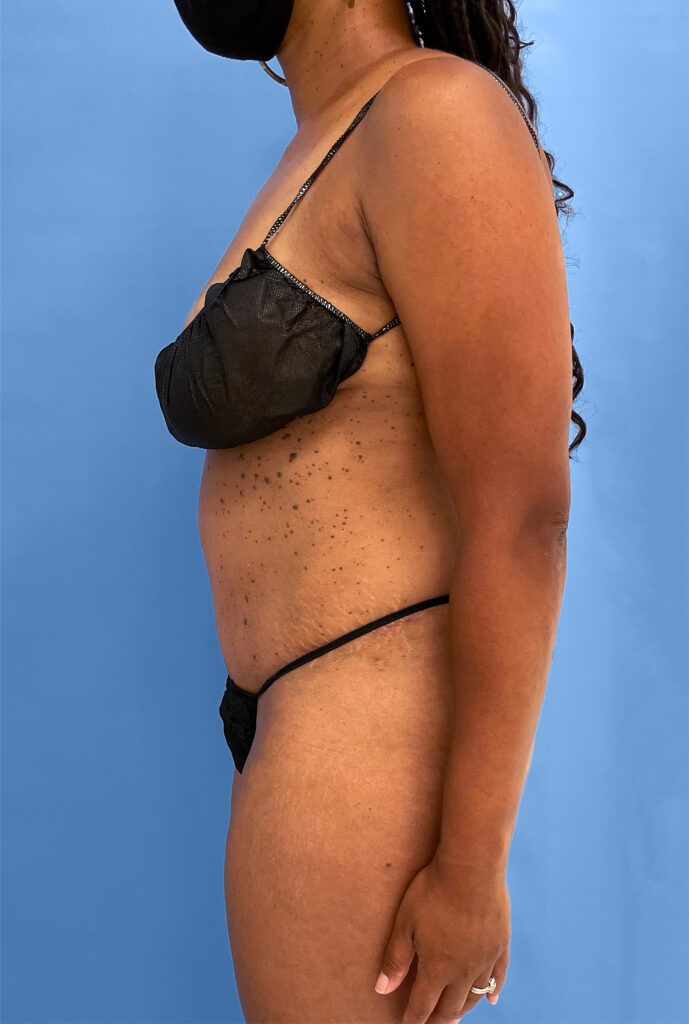 Case TTK-0833 after photo — Dr. Cat, Beverly Hills