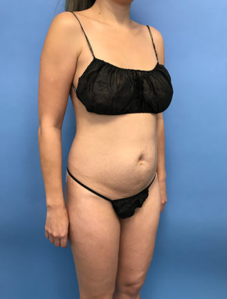 Angled view of patient's abdomen before tummy tuck, highlighting abdominal protrusion and excess skin.