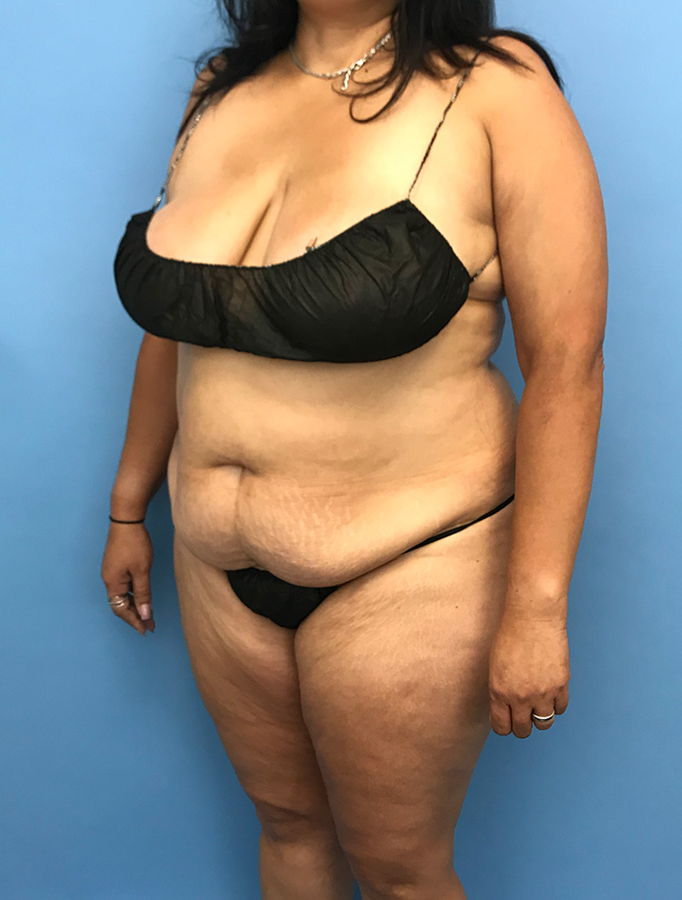 Tummy Tuck before photo angled view - Dr. Cat Beverly Hills