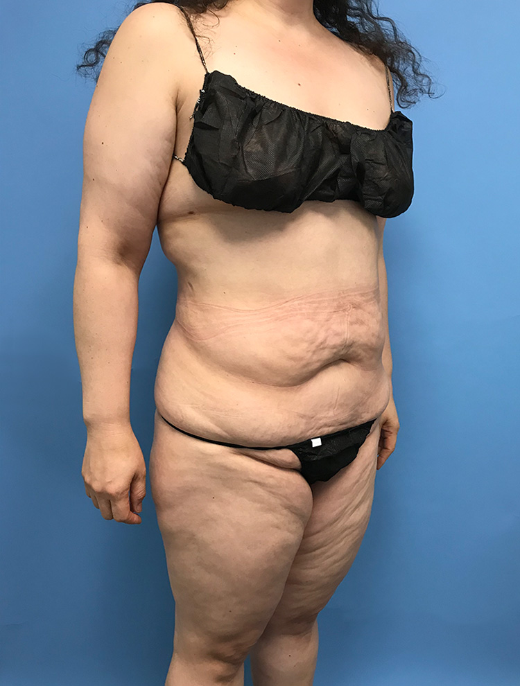 Tummy Tuck before photo angled view - Dr. Cat Beverly Hills