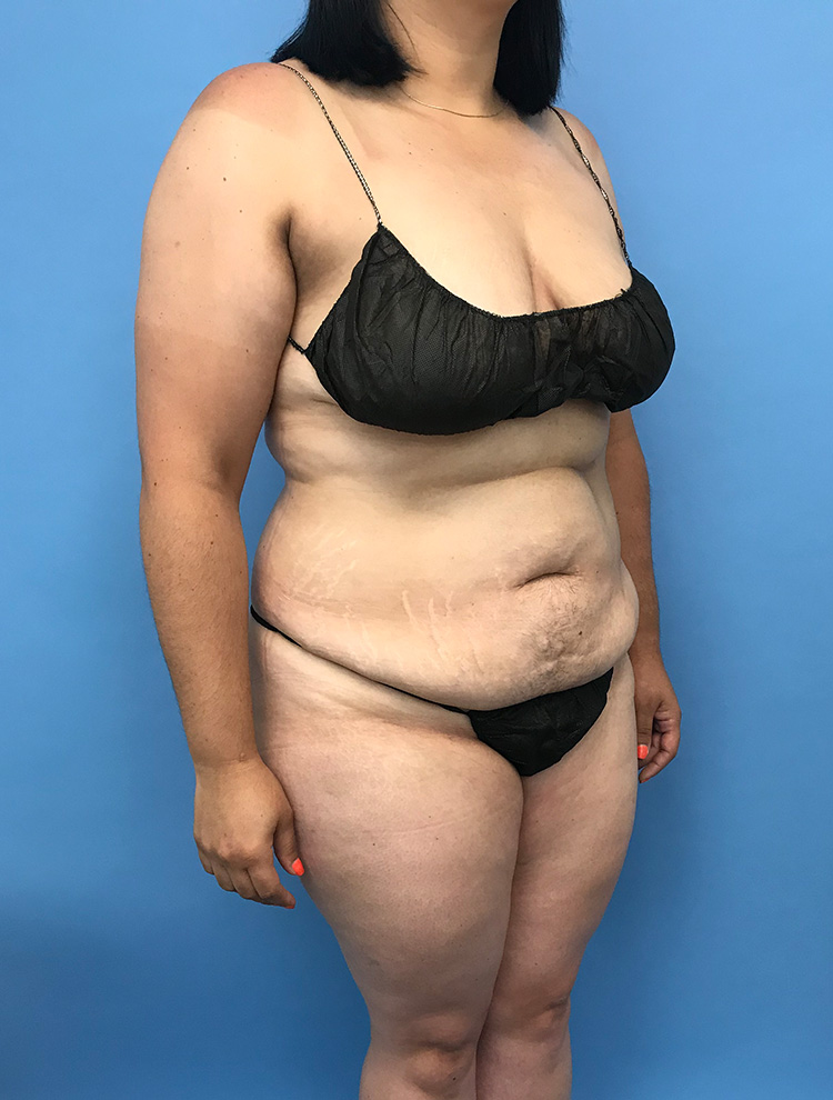 Tummy Tuck before photo angled view - Dr. Cat Beverly Hills