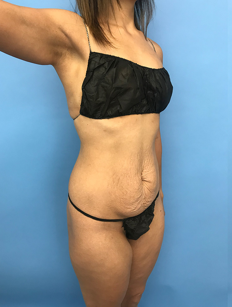 Tummy Tuck before photo angled view - Dr. Cat Beverly Hills