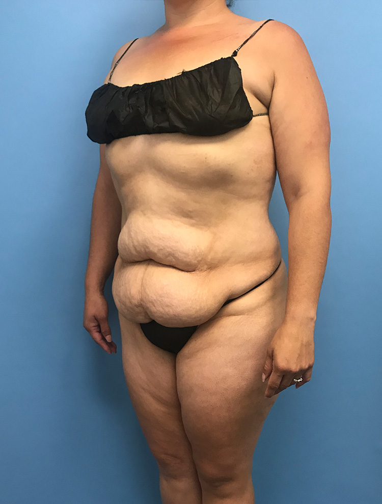 Tummy Tuck before photo angled view - Dr. Cat Beverly Hills
