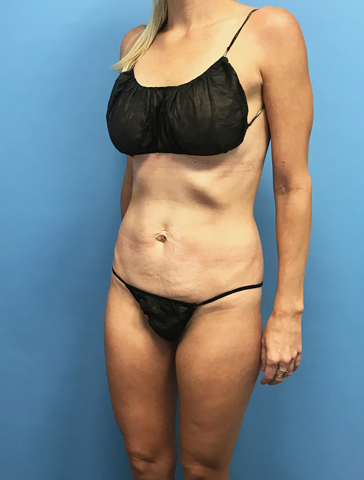Tummy Tuck before photo angled view - Dr. Cat Beverly Hills