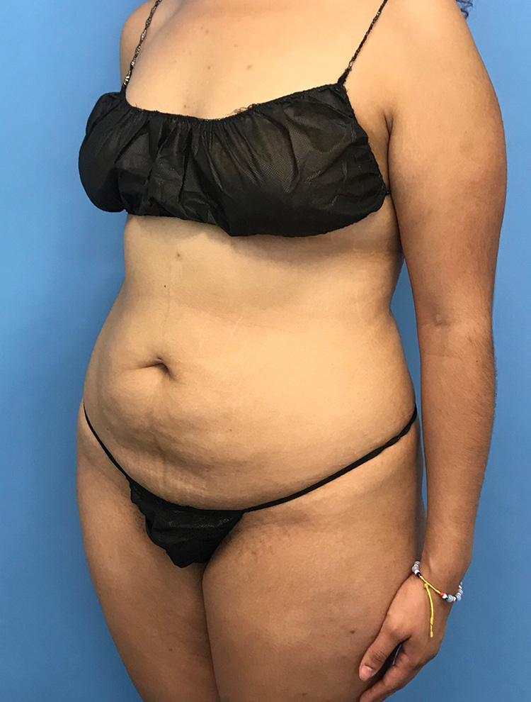 Patient showing side view before tummy tuck surgery, with visible skin laxity and abdominal bulge.