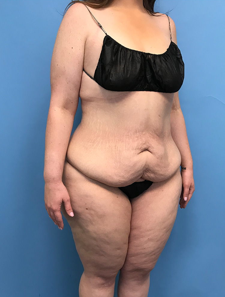 Tummy Tuck before photo angled view - Dr. Cat Beverly Hills