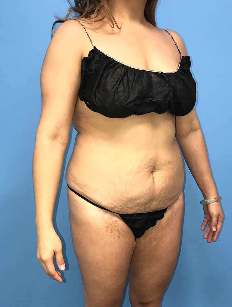 Patient showing side view before tummy tuck surgery, with visible skin laxity and abdominal bulge.