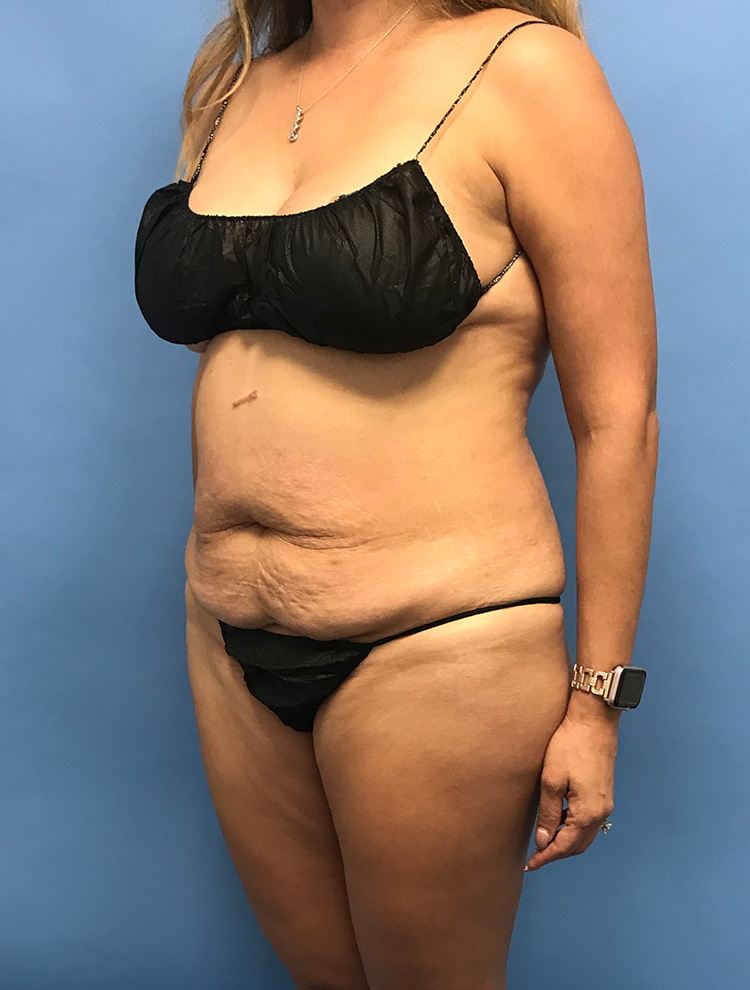 Side profile of a woman before undergoing tummy tuck surgery.