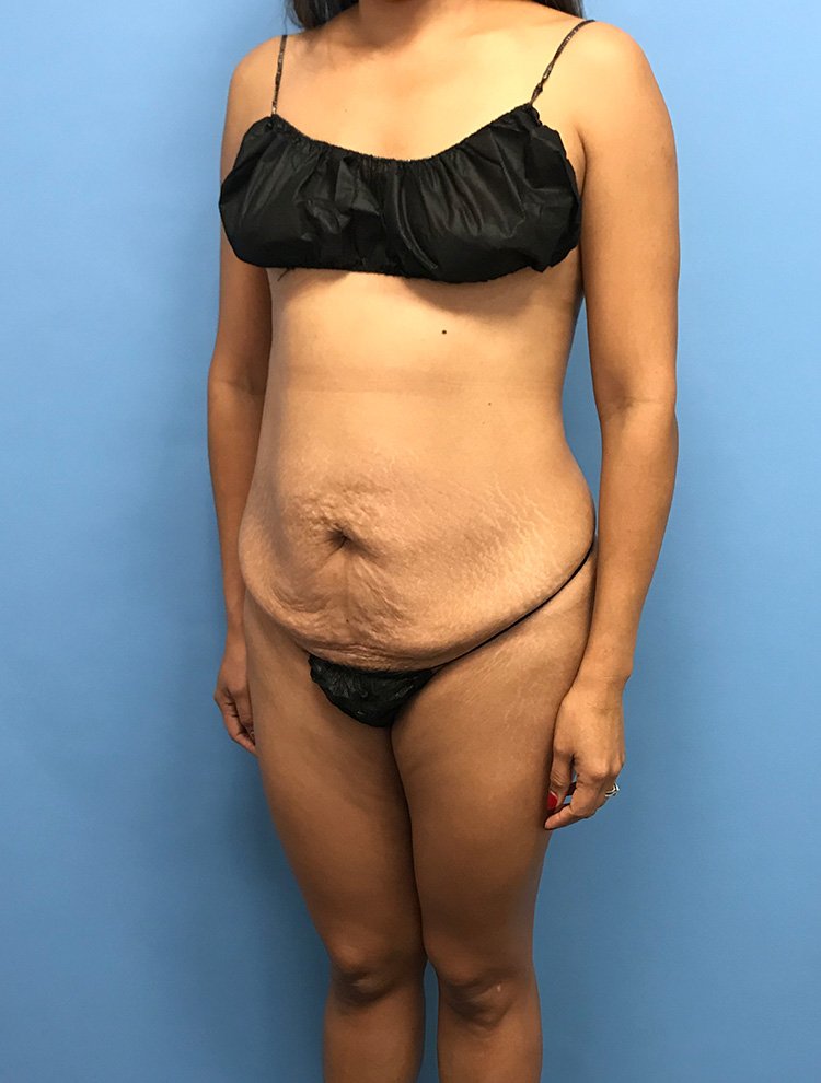 Angled view of a woman before tummy tuck surgery showing loose abdominal skin and muscle laxity