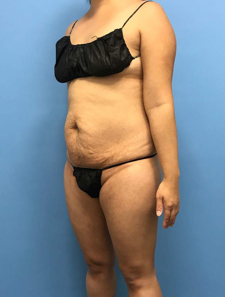 Front angled view of a woman's body before cosmetic body contouring, showing abdomen and body shape targeted for enhancement.