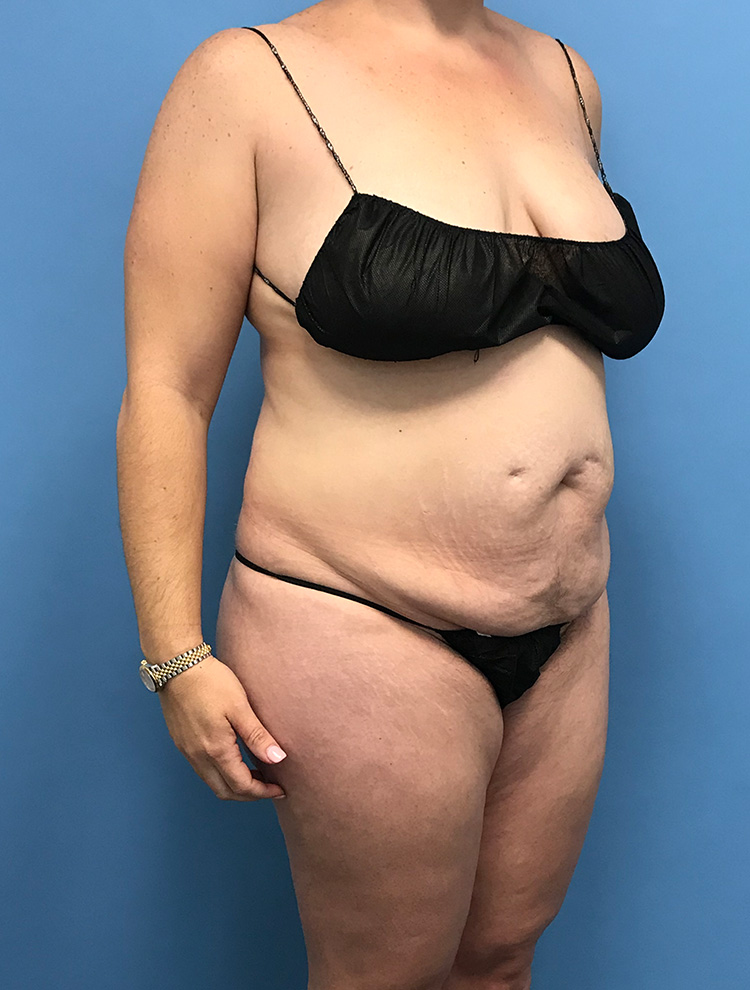 Side profile of a woman before undergoing tummy tuck surgery.