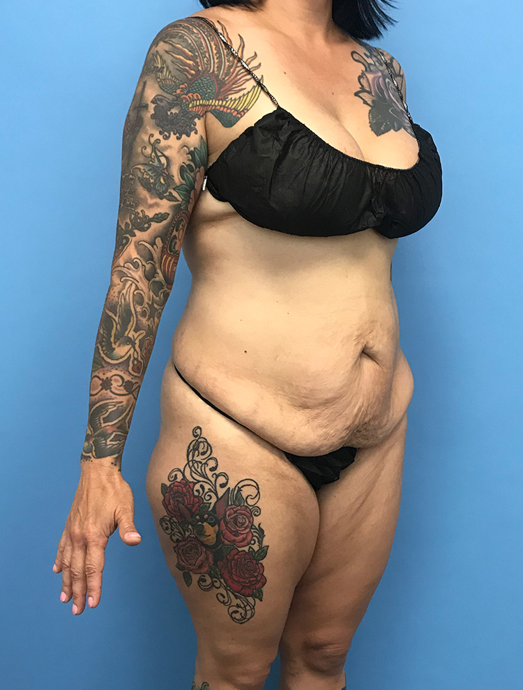 An angled side view of a tattooed female patient before tummy tuck surgery showing loose abdominal skin