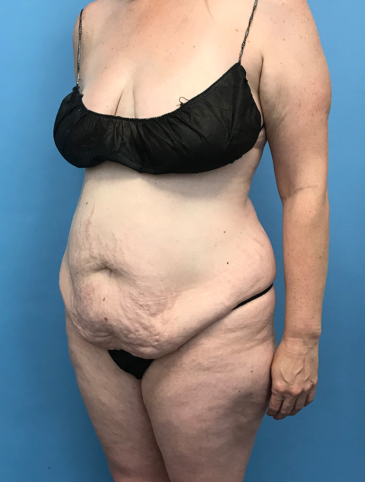 Angled view of a woman's body before tummy tuck surgery, showing excess abdominal skin and tissue.